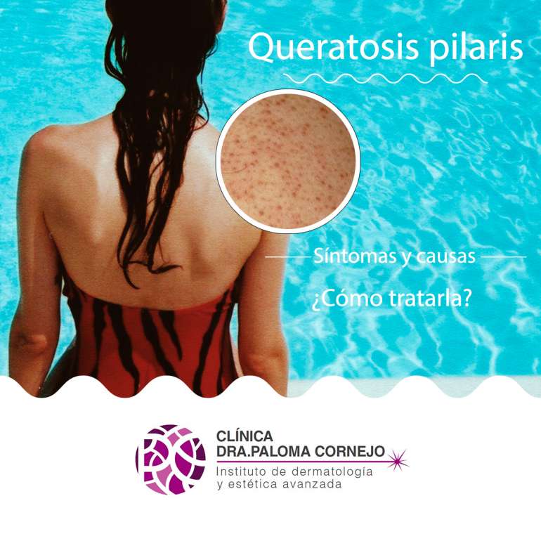 QUERATOSIS PILARIS Paloma Cornejo Más que derma